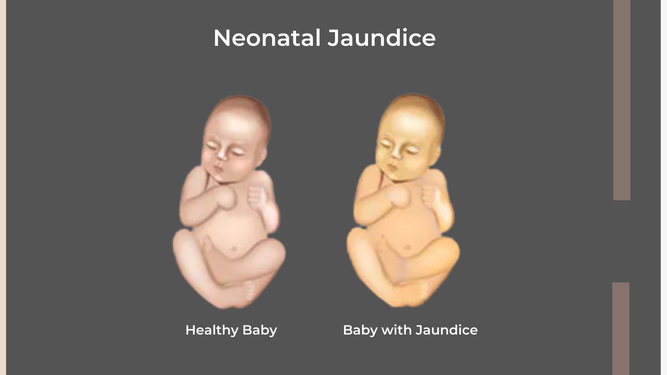 Jaundice In Newborns With And Without