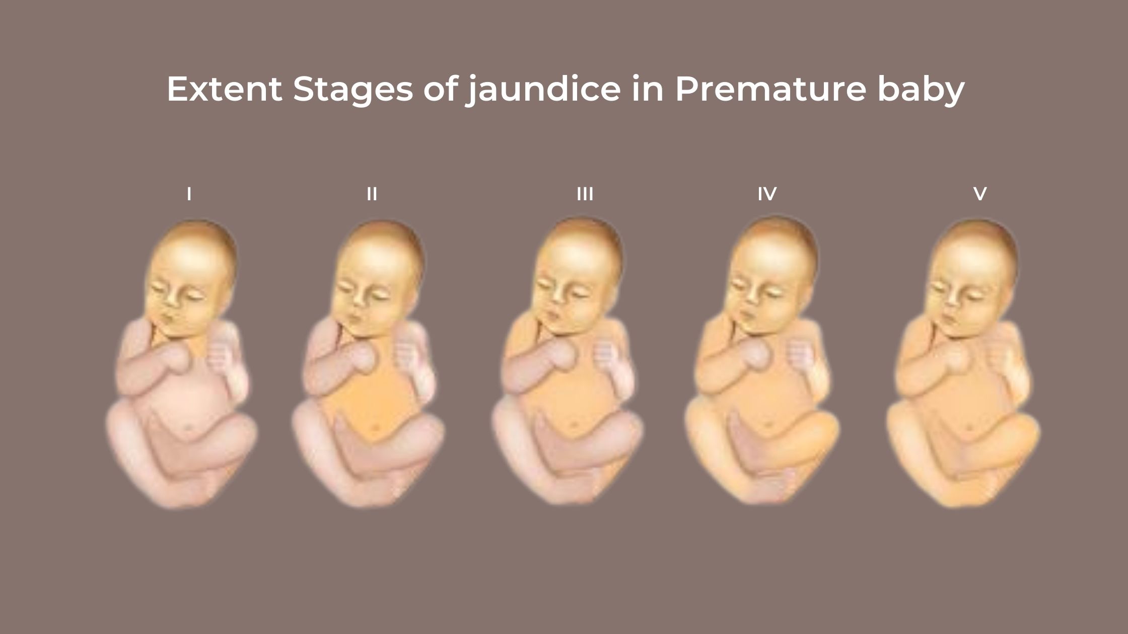 Neonatal Jaundice