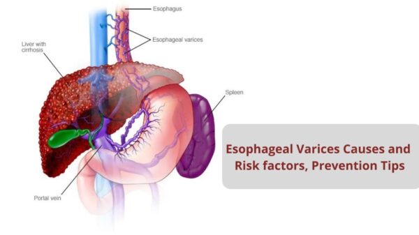 Esophageal Varices: Causes, Risk Factors And Prevention Tips - VIMS