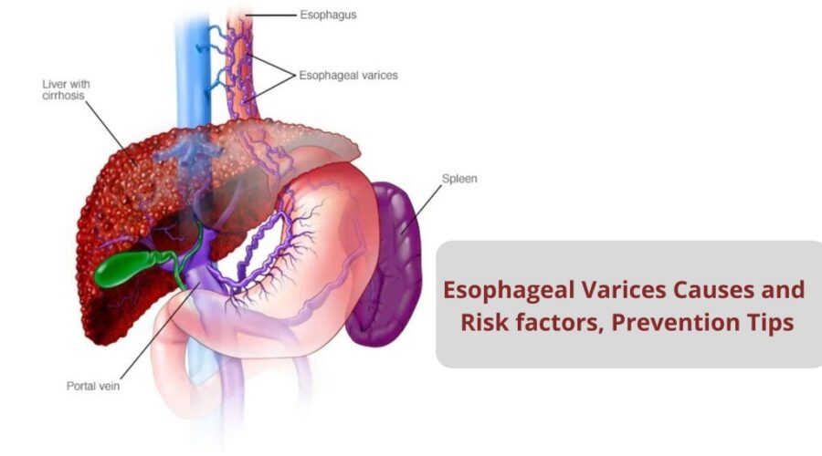 Esophageal varices Causes Risk factors Prevention