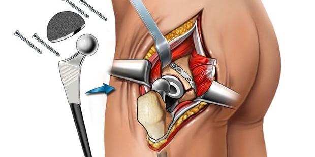 Hip Replacement Surgery