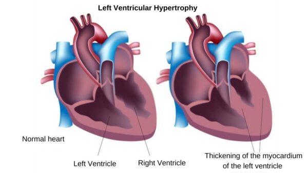 Left Ventricular Hypertrophy (LVH) – Symptoms, Causes and Treatment