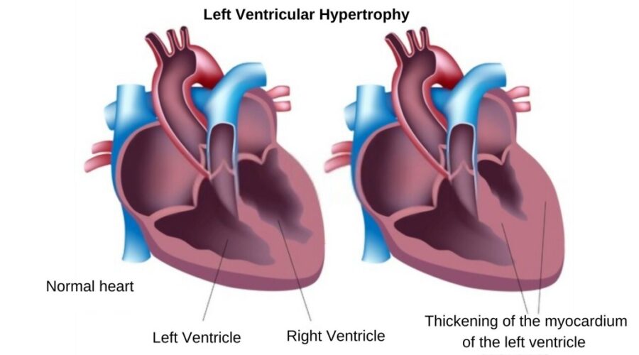 Left ventricular hypertrophy - LHV