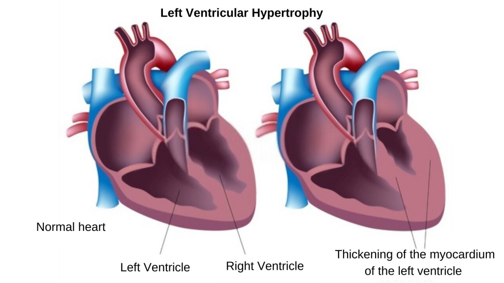 Left ventricular hypertrophy - LHV