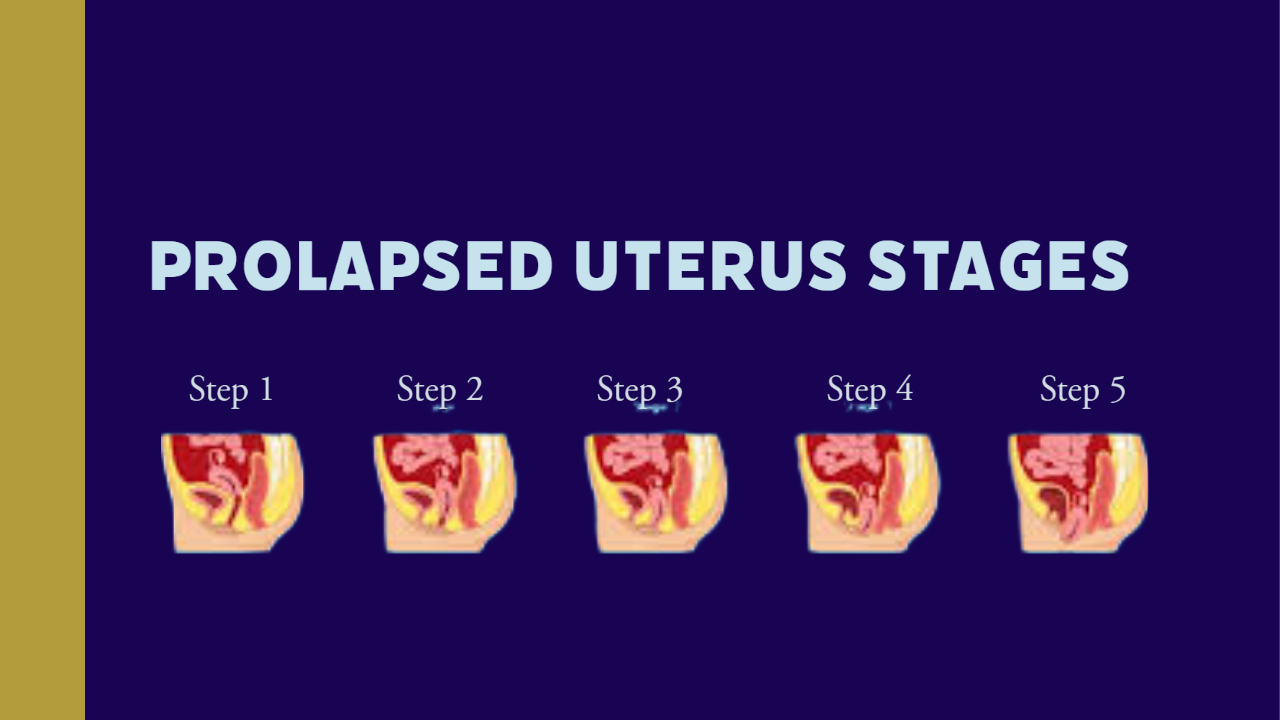 Prolapsed Uterus Stages
