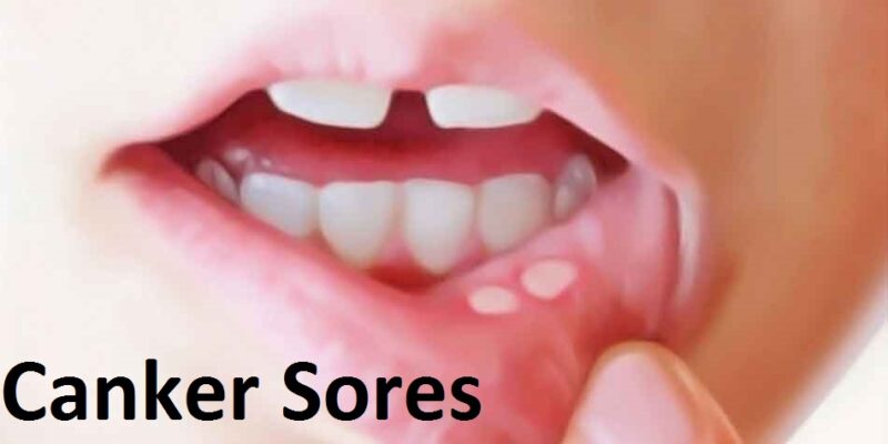 How To Deal With Canker Sores - VIMS