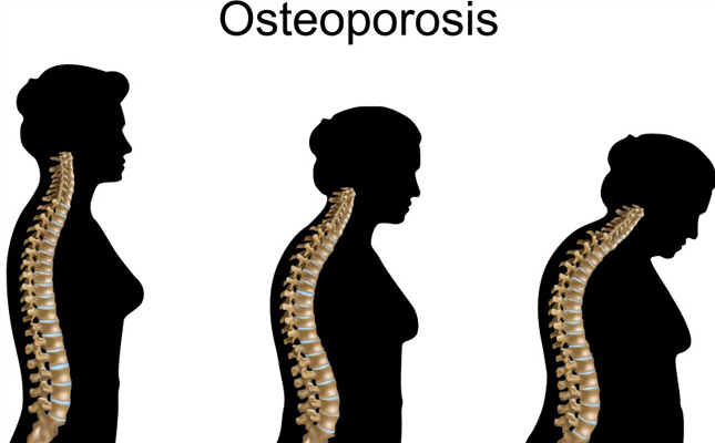 Osteoporosis in Women in India