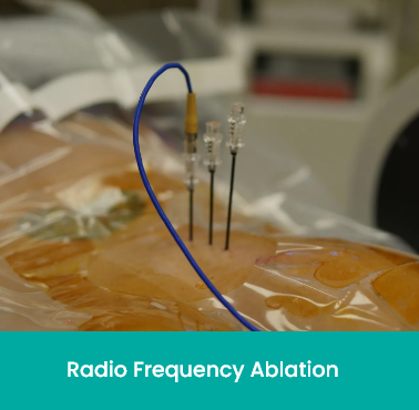 radio frequency ablation