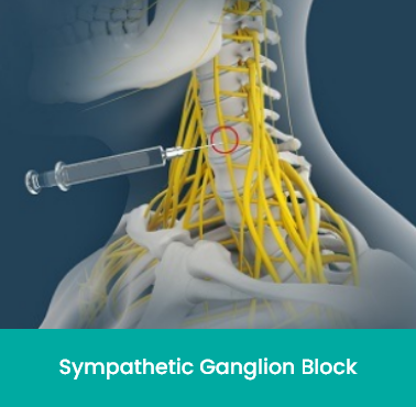 sympathetic ganglion block