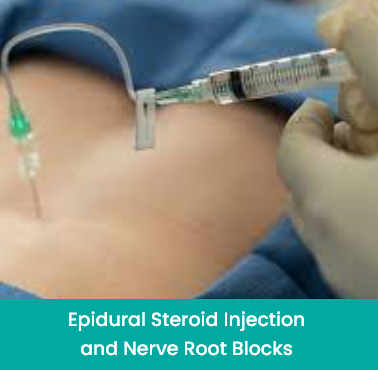 epidural steroid injection and nerve root blocks
