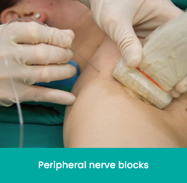 Peripheral nerve blocks