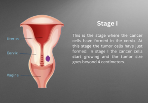 stage 1 Cervical Cancer
