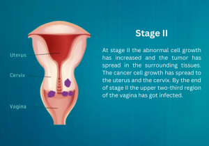Cervical Cancer stage 2