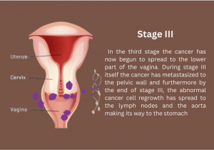stage 3 Cervical Cancer