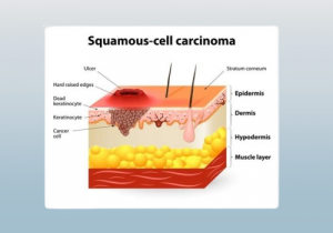 Squamous Cell Carcinoma infographic image