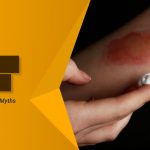 Myths About Burns