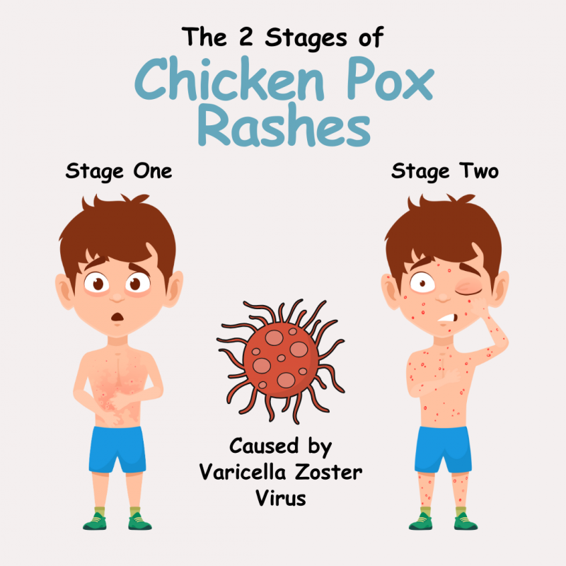 Debunking the Myths: Separating Fact from Fiction About Chicken Pox - VIMS