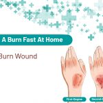 heal burnss at home