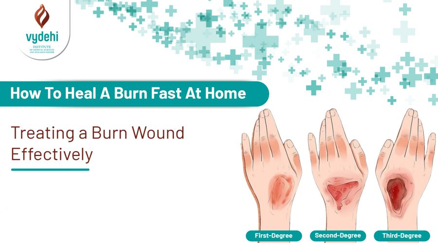 heal burnss at home