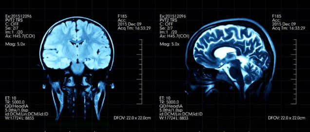 MRI Scan of the Brain