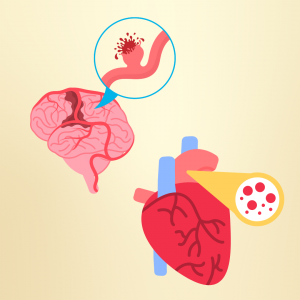 Embolic Stroke