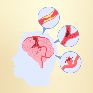 Thrombotic Stroke