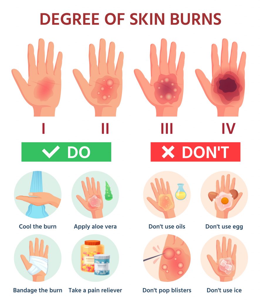 Burn First Aid-What to Do Immediately