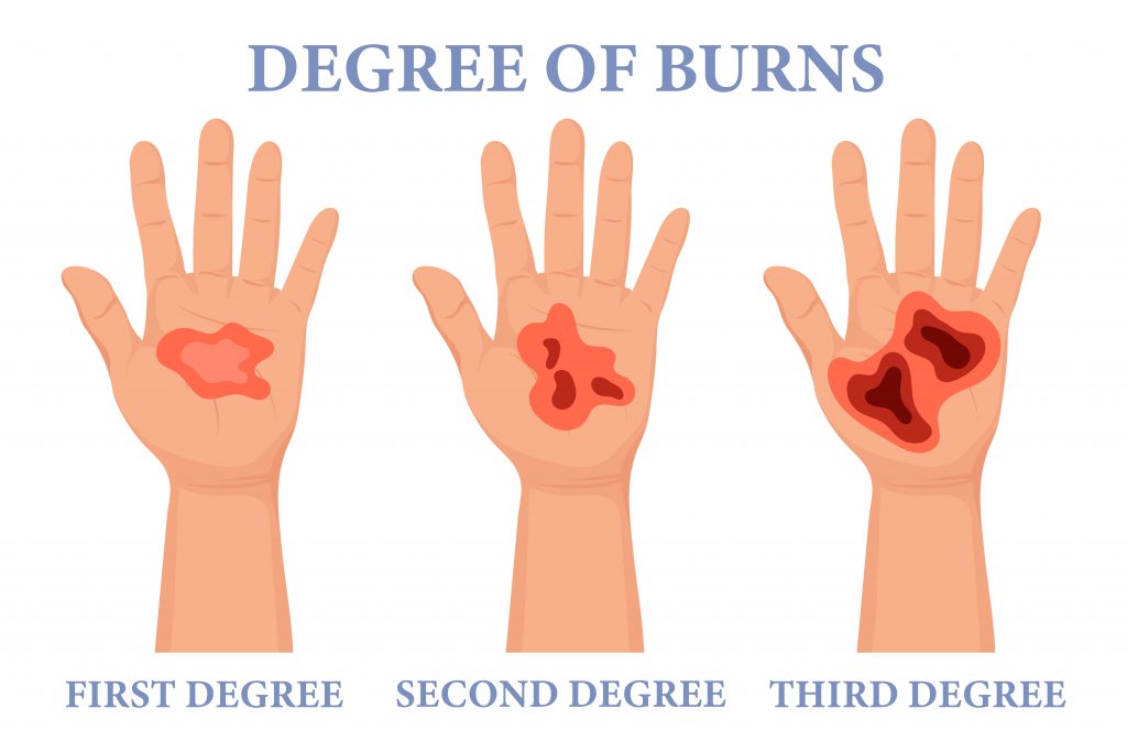 Degree of burns