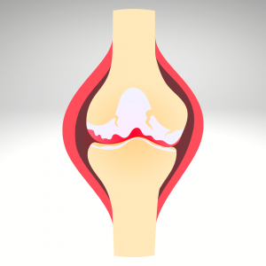 Joint pain and stiffness