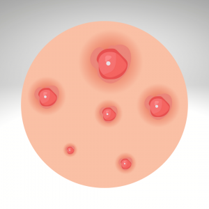 Skin Diseases in Children