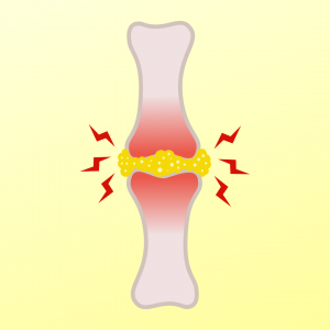 Arthritis and Joint Pain