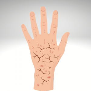 Bluish lips or fingertips in severe cases