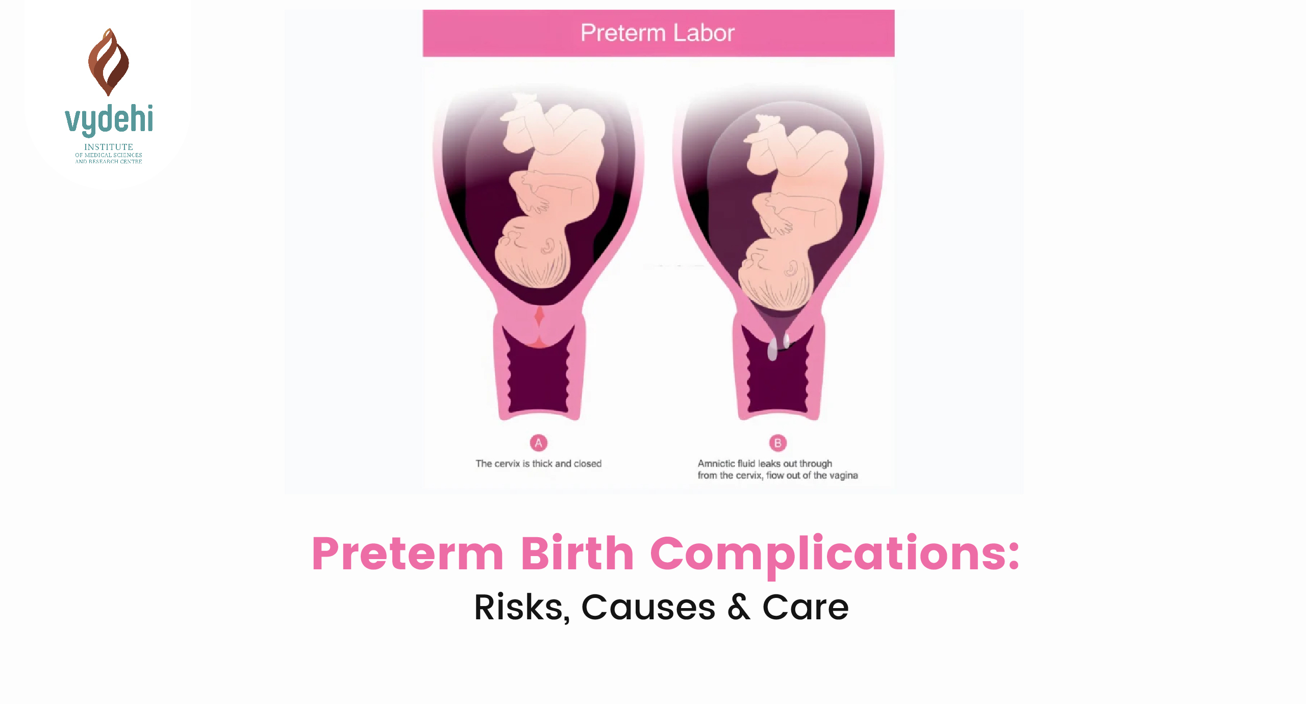 Preterm Birth Complications
